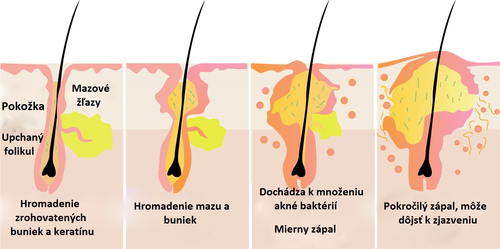 Popis vzniku akné