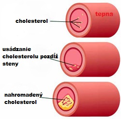 upchávanie ciev