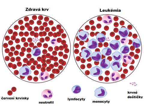 leukémia